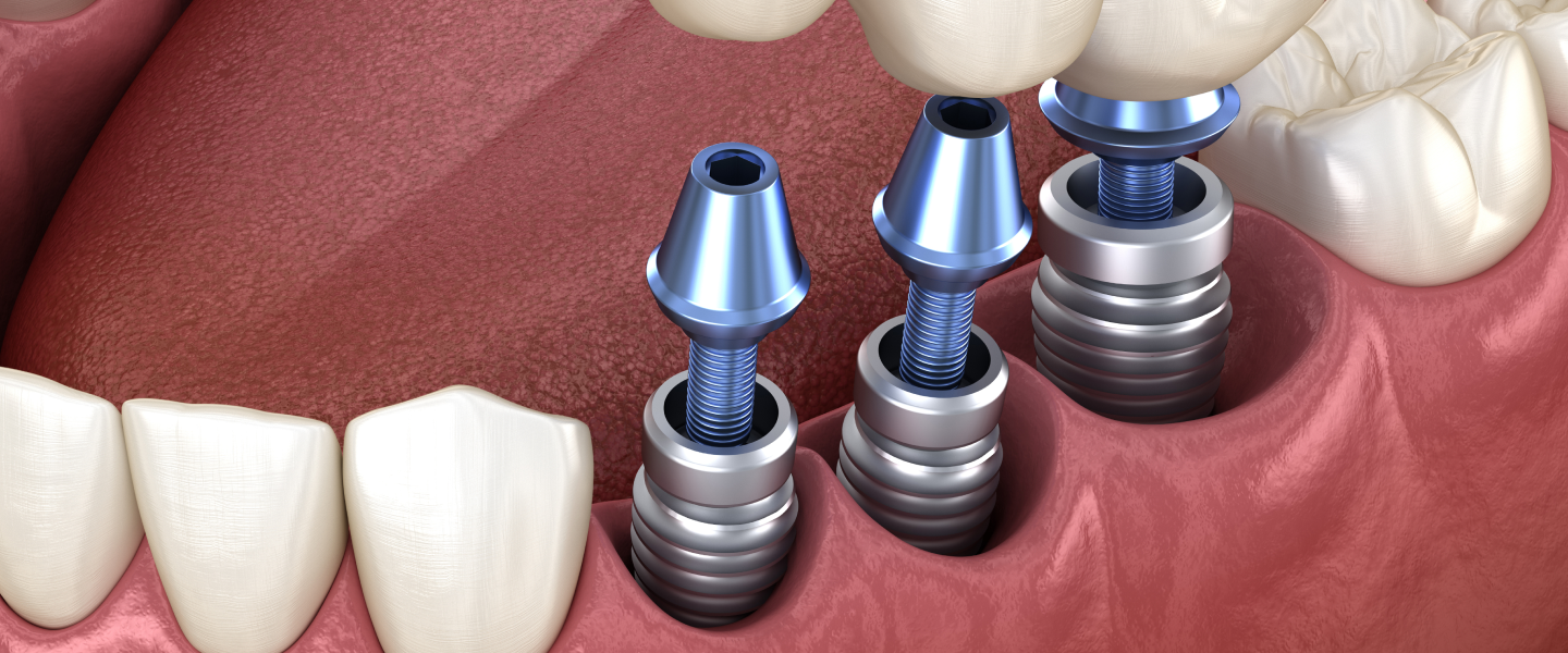 The Ultimate Guide to Choosing the Right Dental Restoration Services