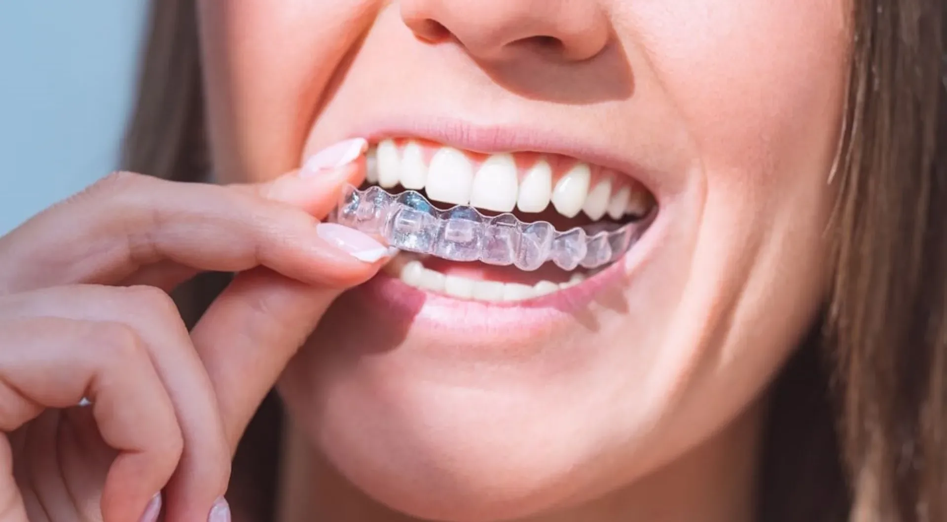 Straighten your teeth discreetly with Invisalign Aligners