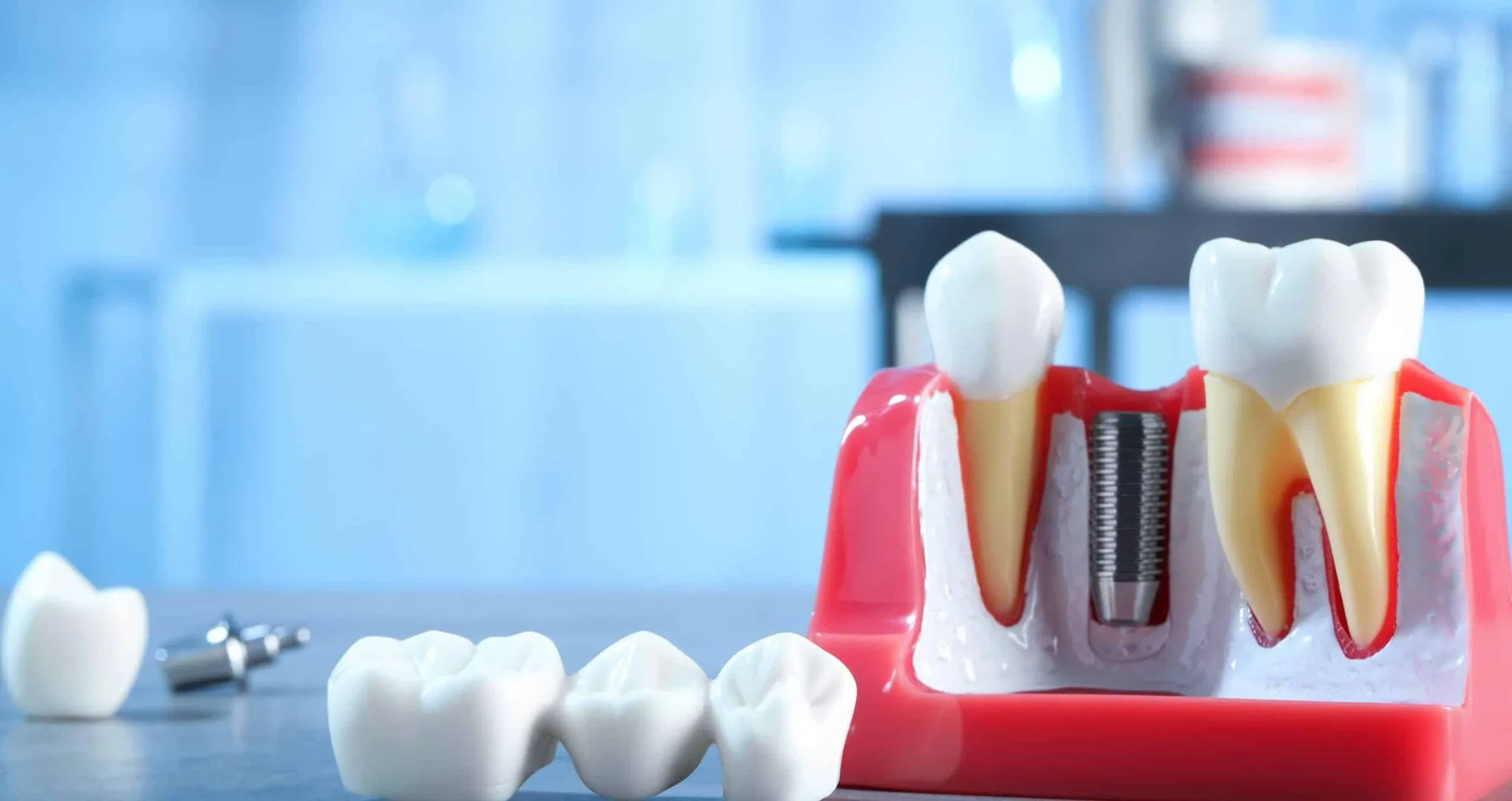 Dental implant alternatives and essential considerations