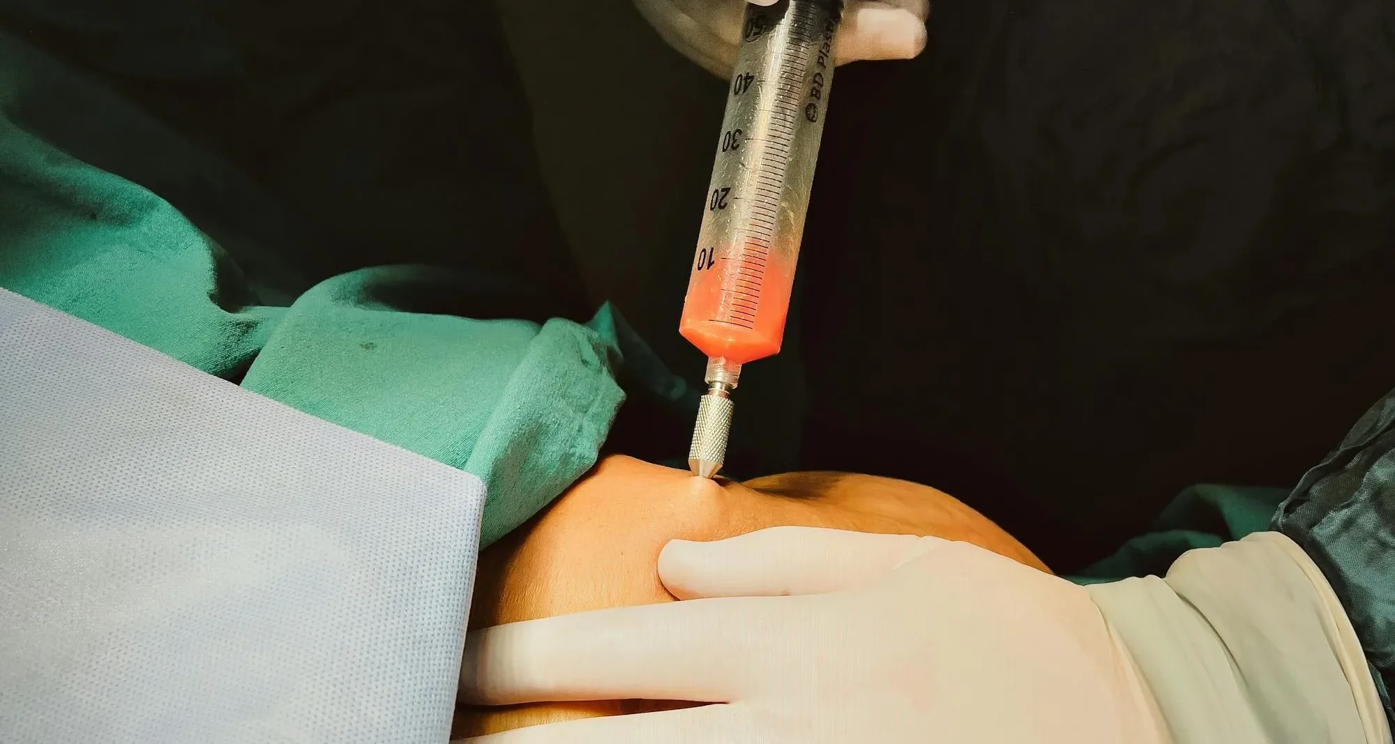 Fat dissolving treatment: Safe, fast and effective