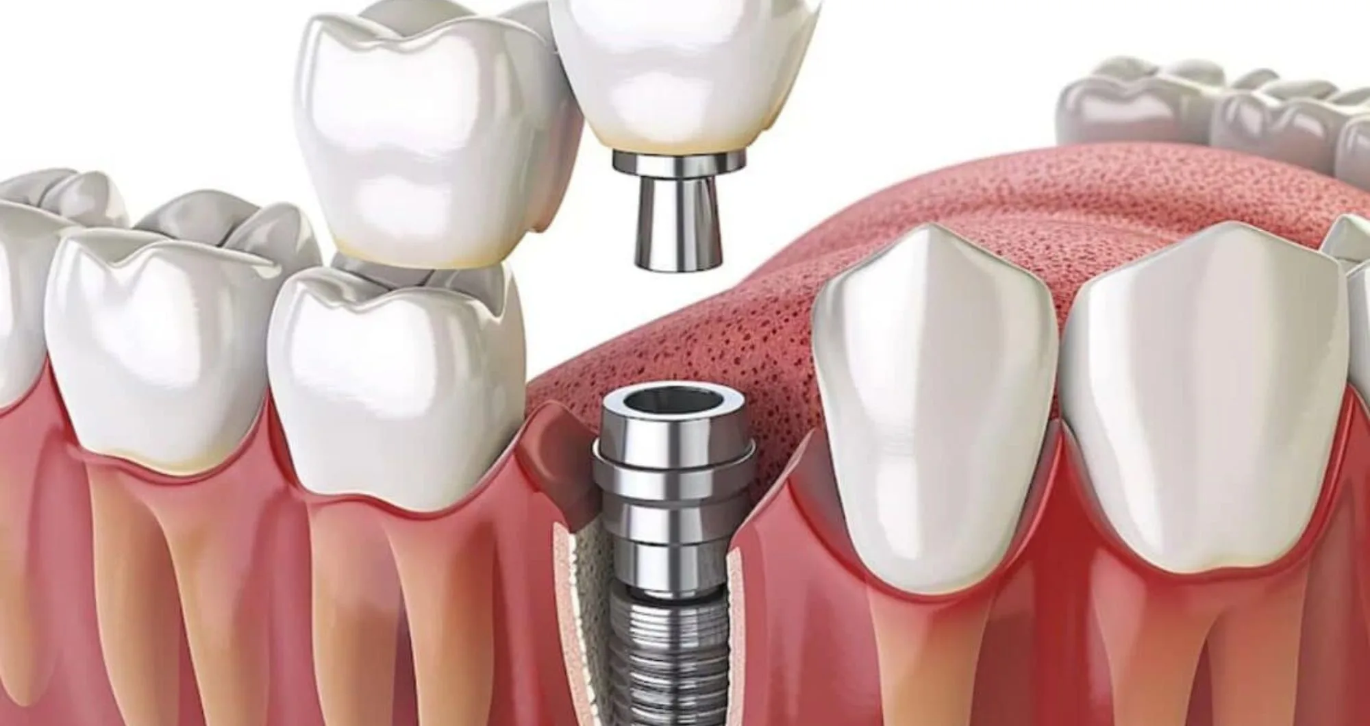 Dental Implant in Hassocks: Your complete guide