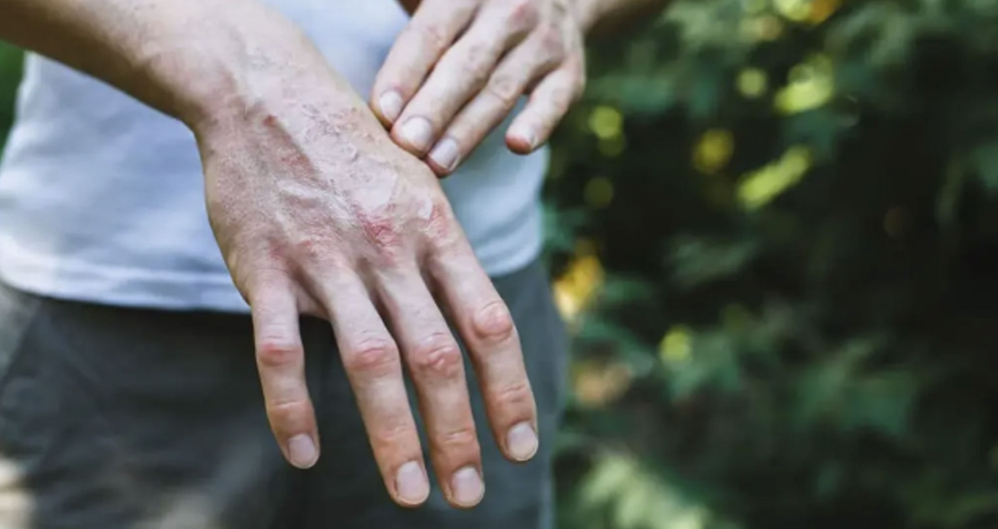 Psoriatic arthritis: Understanding the condition beyond the joints
